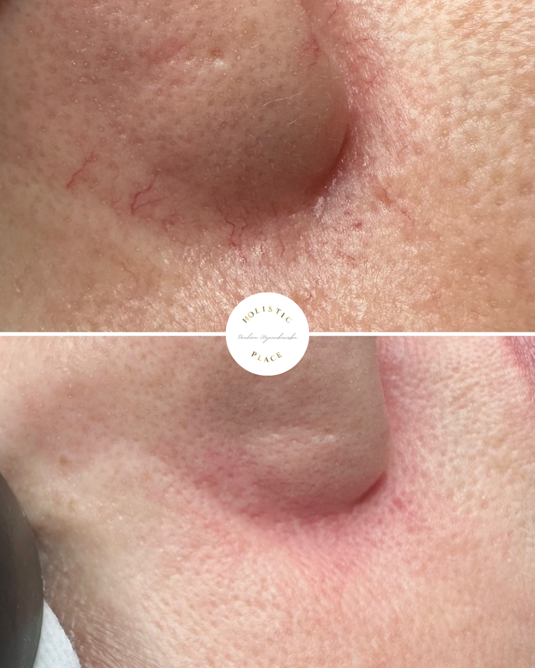 Efekt zabiegu przed i po