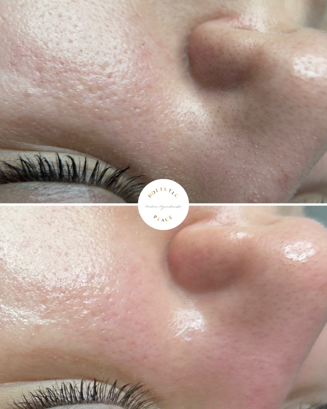 Efekt zabiegu przed i po