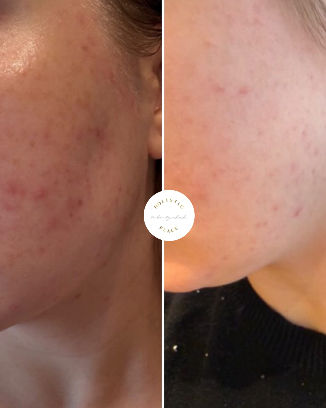 Efekt zabiegu przed i po