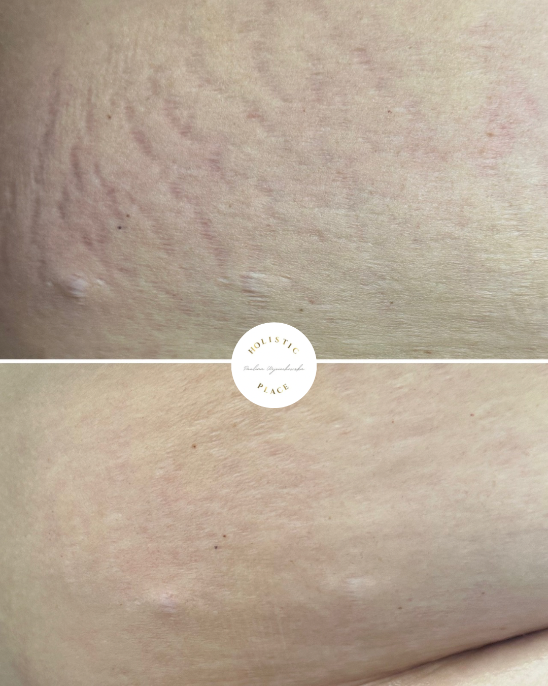 Efekt zabiegu przed i po