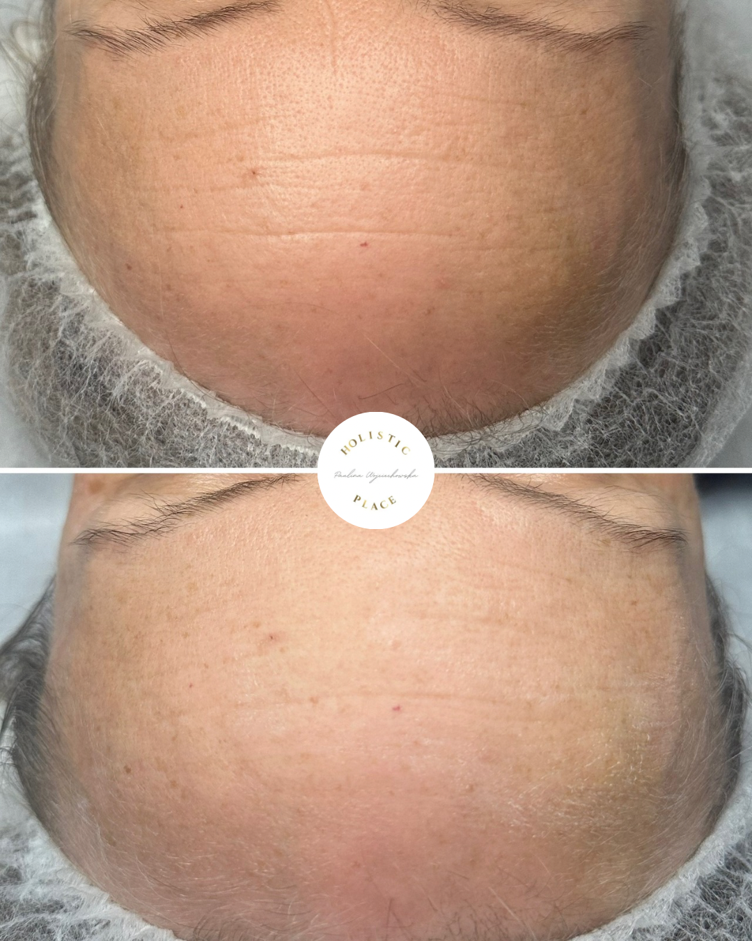 Efekt zabiegu przed i po