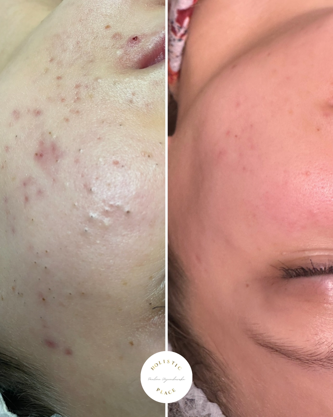 Efekt zabiegu przed i po