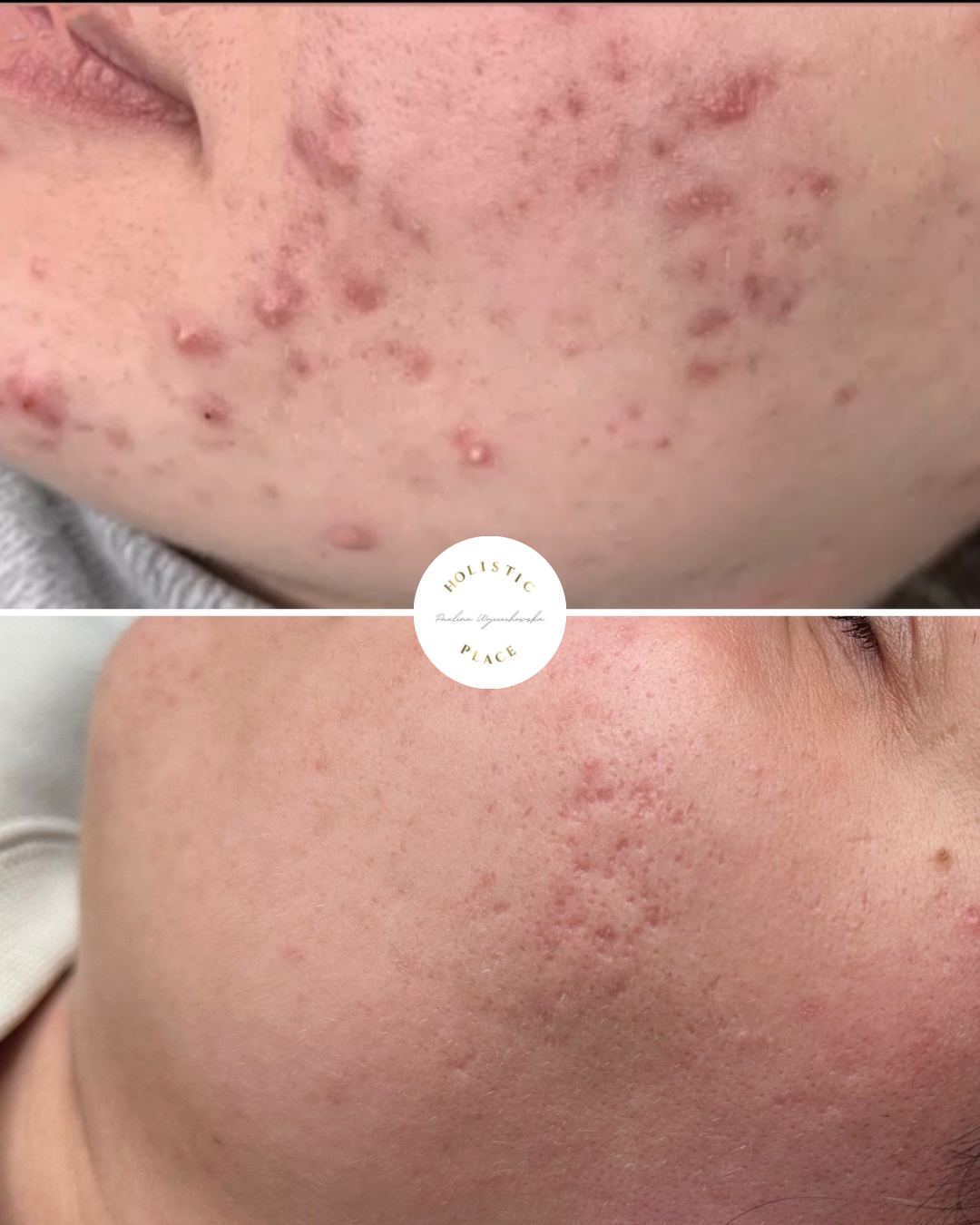 Efekt zabiegu przed i po