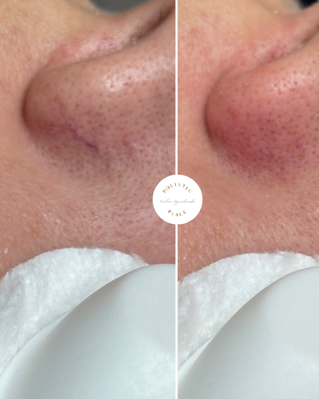 Efekt zabiegu przed i po