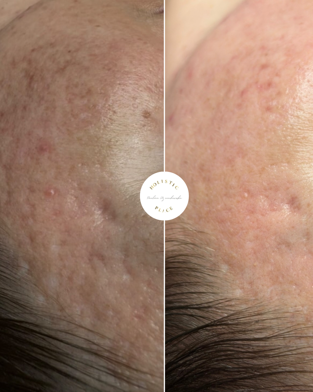 Efekt zabiegu przed i po