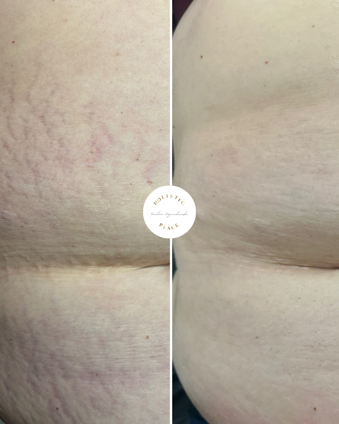 Efekt zabiegu przed i po