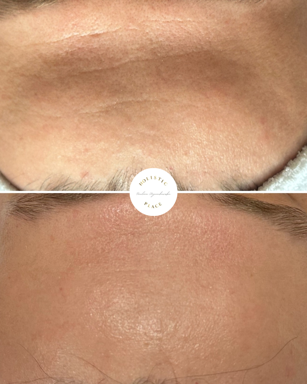 Efekt zabiegu przed i po