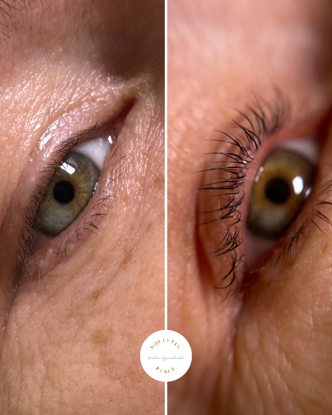 Efekt zabiegu przed i po