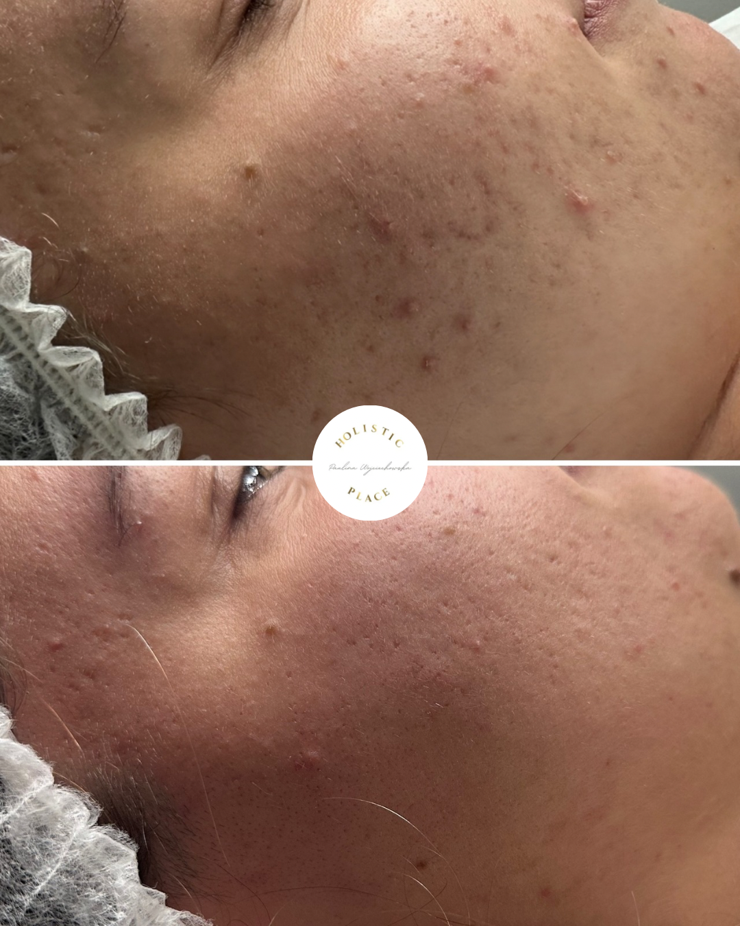 Efekt zabiegu przed i po