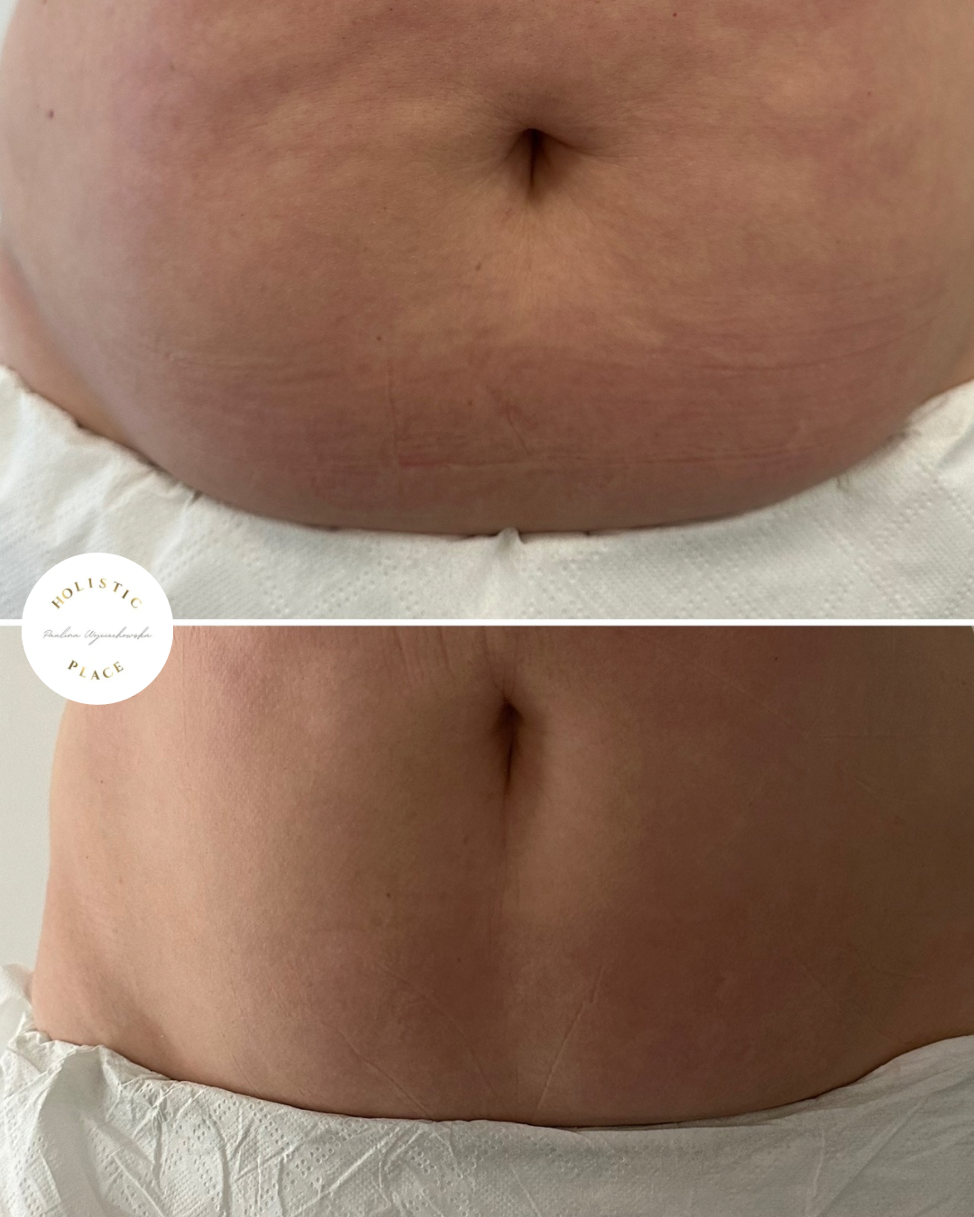 Efekt zabiegu przed i po