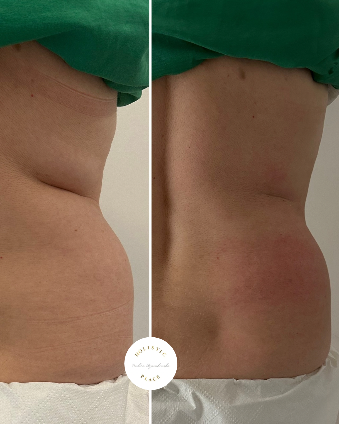 Efekt zabiegu przed i po