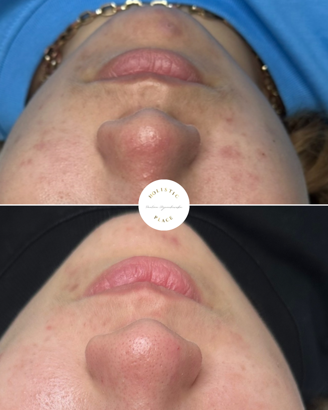 Efekt zabiegu przed i po