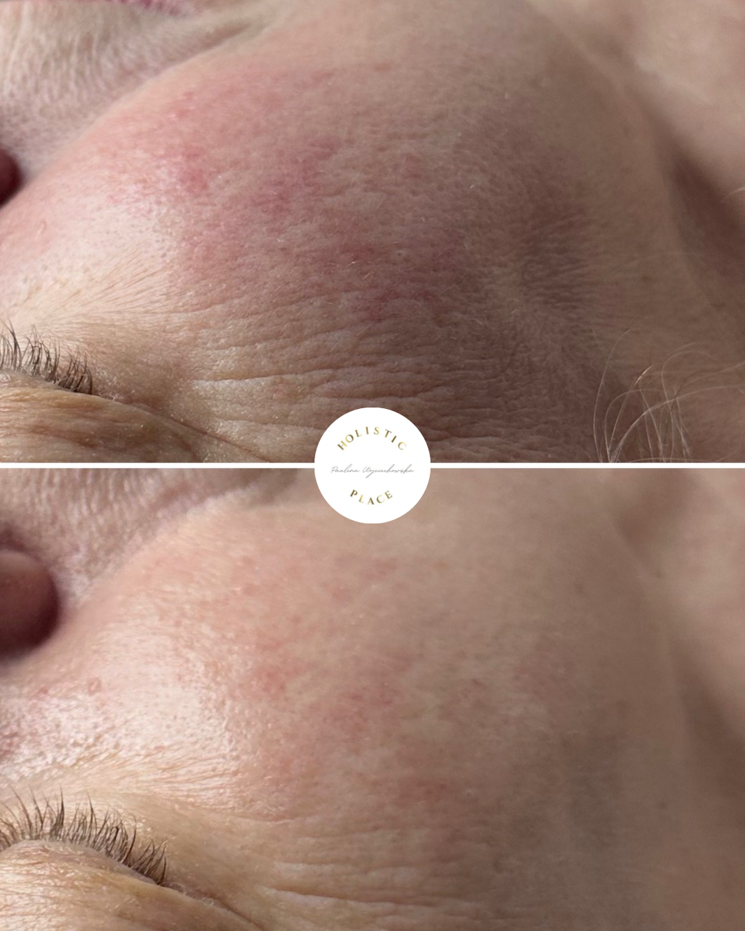 Efekt zabiegu przed i po