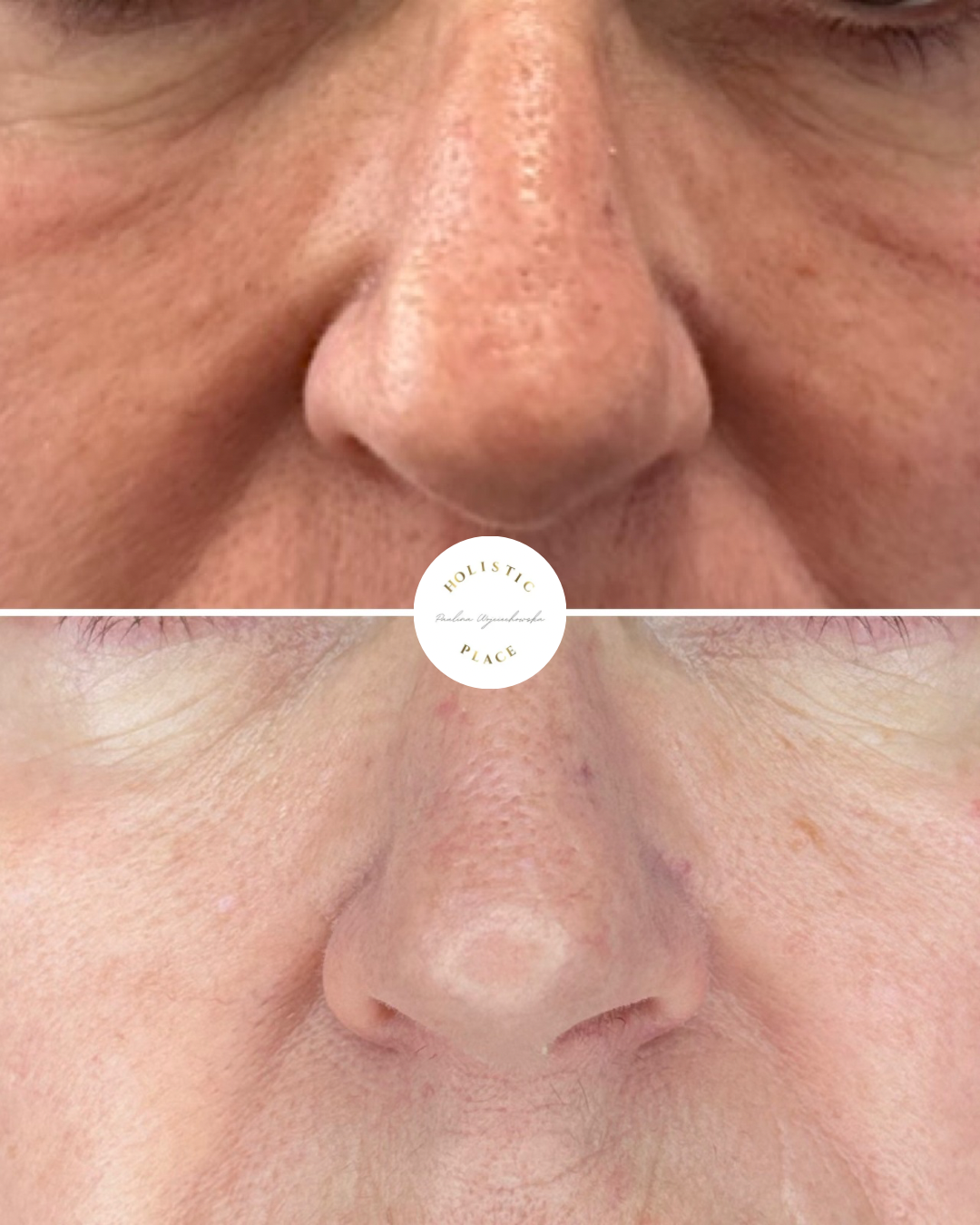 Efekt zabiegu przed i po