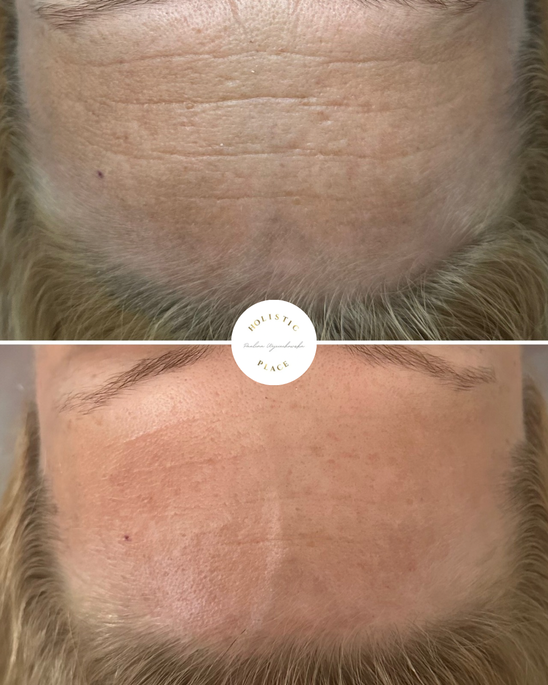 Efekt zabiegu przed i po