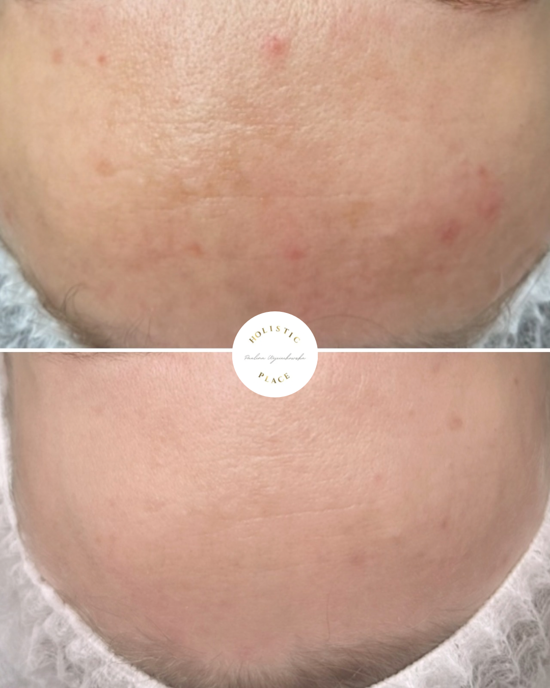 Efekt zabiegu przed i po