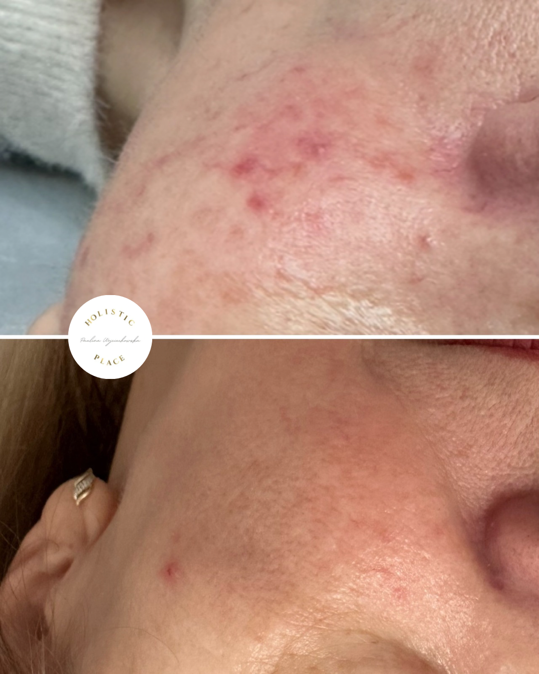 Efekt zabiegu przed i po