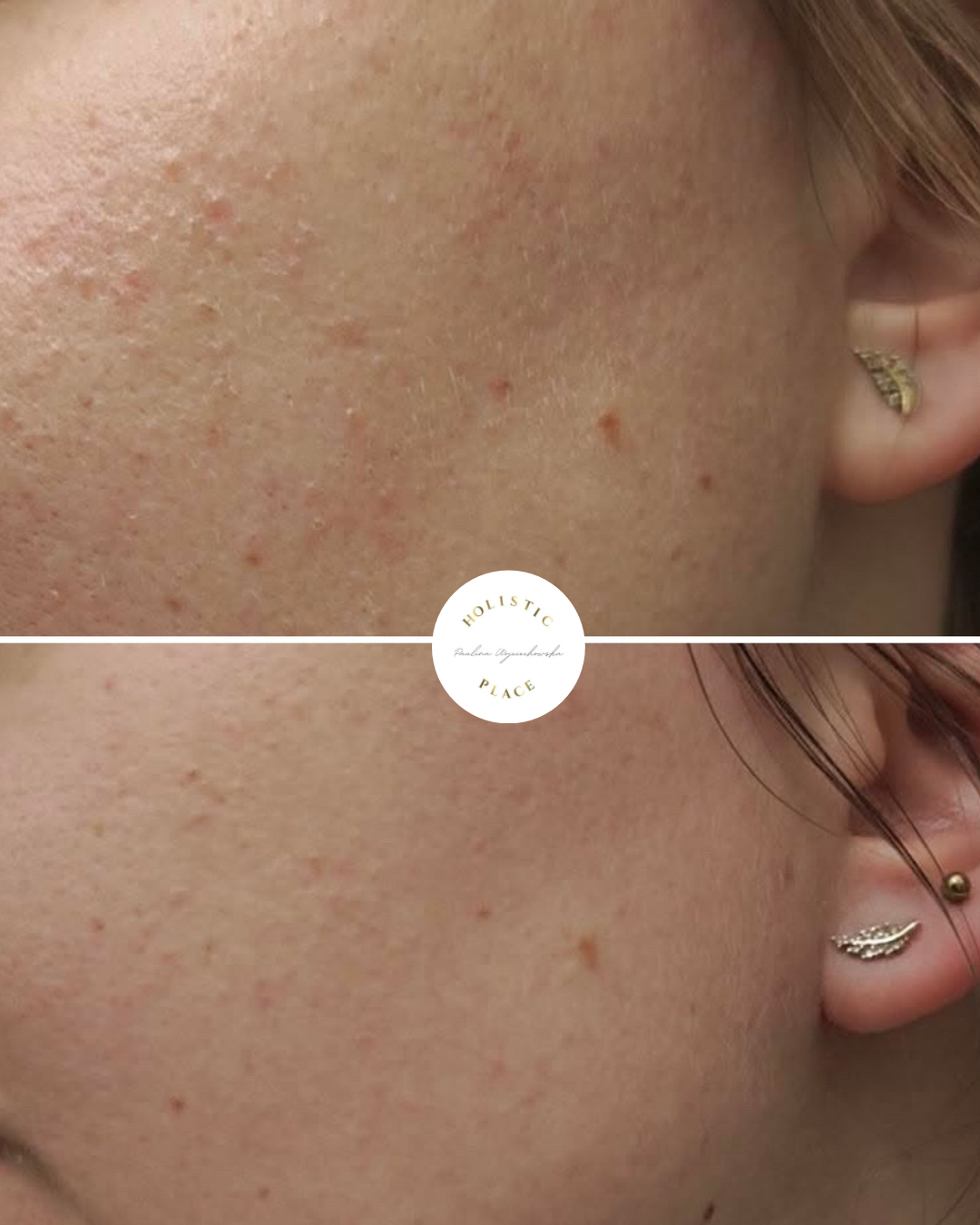 Efekt zabiegu przed i po