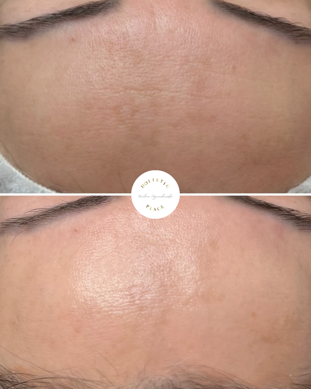 Efekt zabiegu przed i po