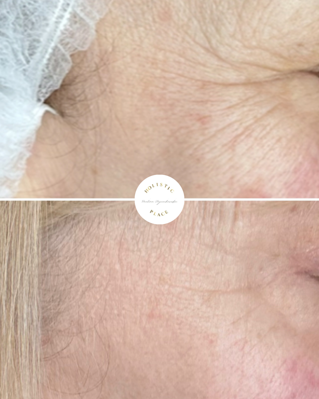 Efekt zabiegu przed i po