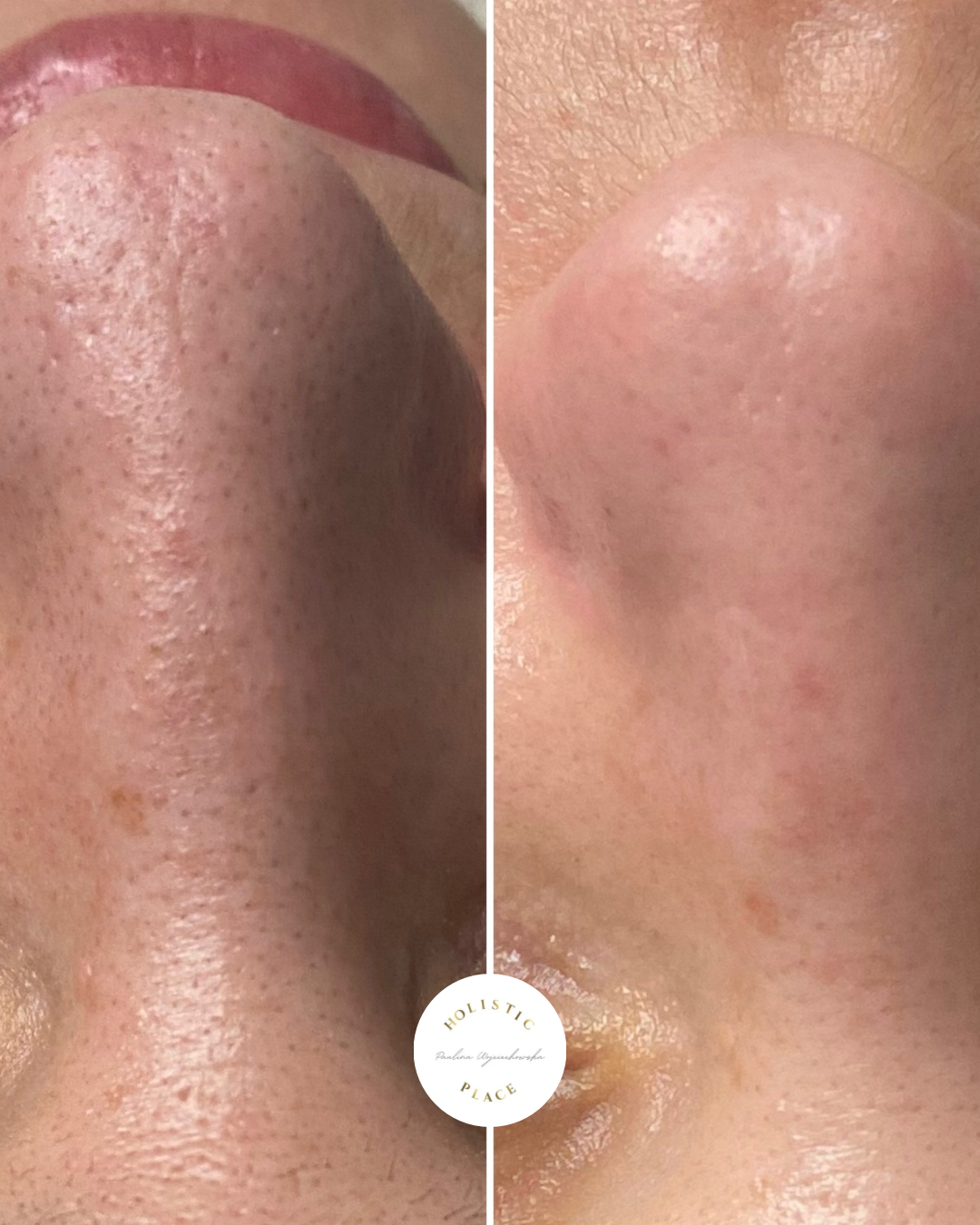 Efekt zabiegu przed i po