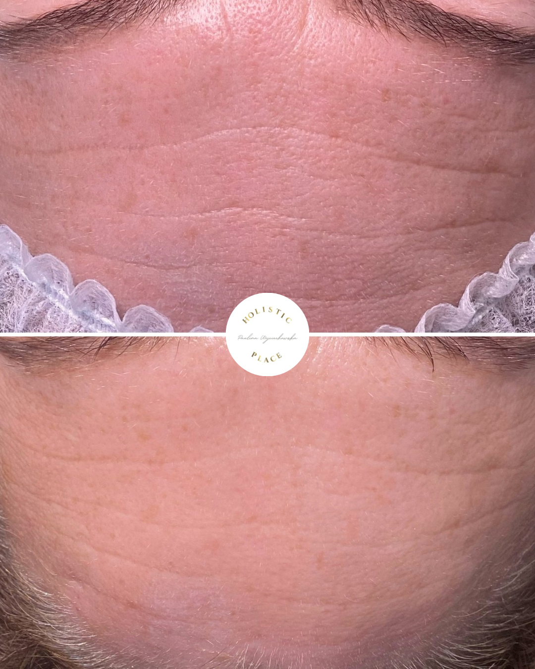 Efekt zabiegu przed i po