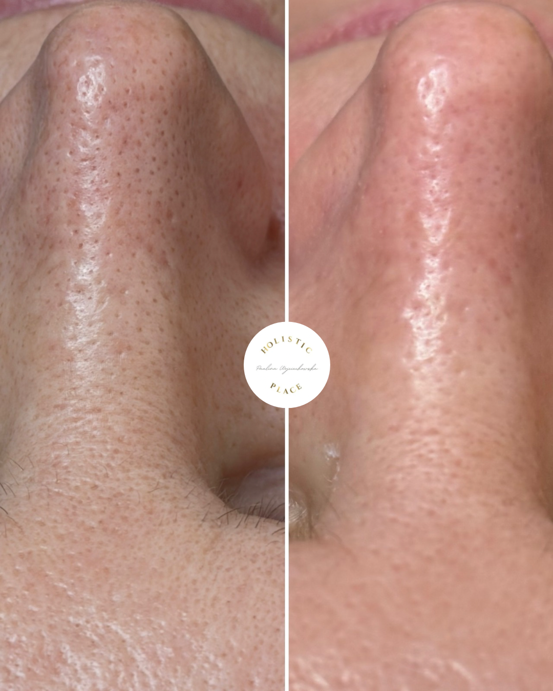 Efekt zabiegu przed i po