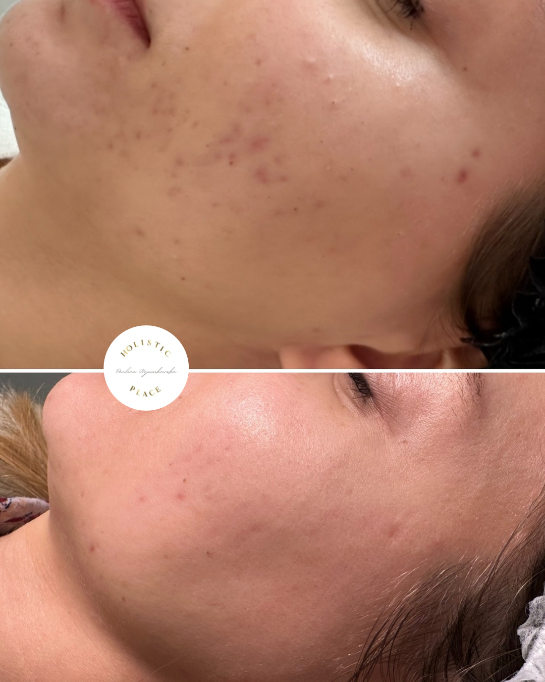 Efekt zabiegu przed i po